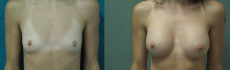 vai alla pagina sulla mastoplastica additiva mastoplastica additiva