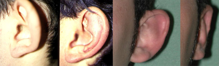 otoplastica